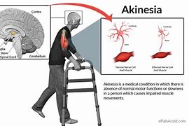Image result for axinesia