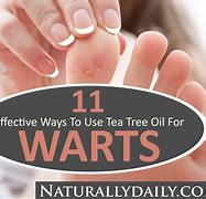 Image result for Tea Tree Oil Wart Removal