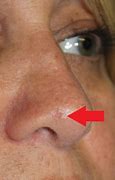 Image result for Skin Cancer On My Nose