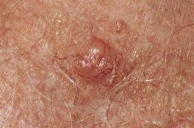 Image result for Skin Cancer in Hair