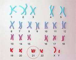 Image result for Down Syndrome Chromosome