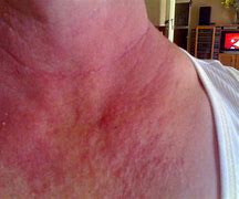 Image result for Itchy Rash On Chest and Neck