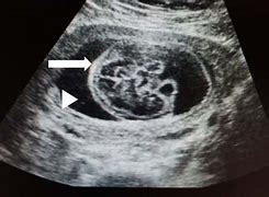 Image result for Acrania Fetal Ultrasound