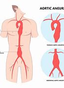 Image result for Dilated Aortic Root