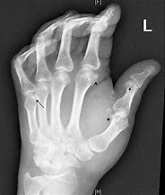 Image result for Accessory Sesamoid Bone Hand