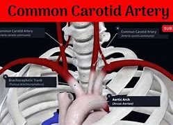 Image result for Carotid Artery Web