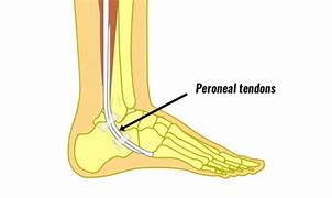 Image result for Peroneal Dislocation