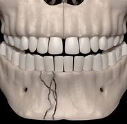 Image result for Jawbone Breaks