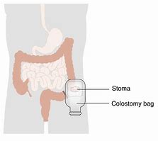 Image result for Ileostomy Stoma Colostomy Bag