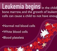 Image result for Pediatric Leukemia