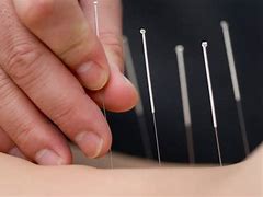 Image result for acupunturs