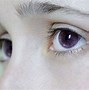 Image result for Heterozygous Eyes