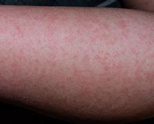 Image result for Kid Virus with Rash