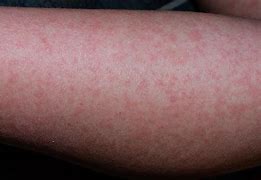 Image result for Viral Skin Rashes in Children