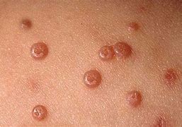 Image result for HPV Warts vs Molluscum