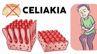 Image result for celiakia