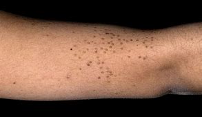 Image result for Wart On Forearm