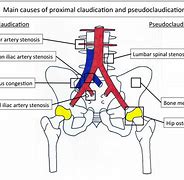 Image result for Aortoiliac Bypass