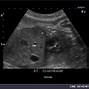 Image result for Fetal Kidneys Ultrasound