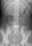 Image result for Spring Clip Surgical