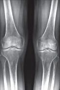 Image result for Osteoporosis Knee