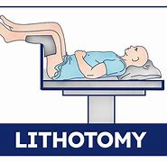 Image result for Lithotomy Position