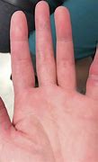 Image result for Swollen Pinky Finger