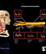 Image result for Carotid Artery Bruit
