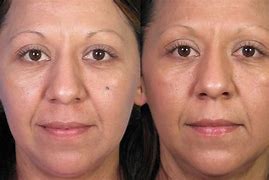 Image result for Mole Removal On Face Scarring
