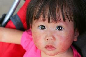Image result for Fifth Disease in Young Children