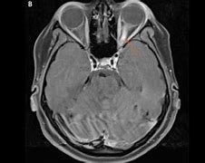 Image result for Where Is the Optic Nerve