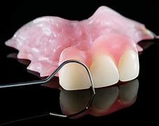 Image result for Partial Denture Lateral Incisors