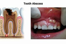 Image result for Odontogenic Abscess
