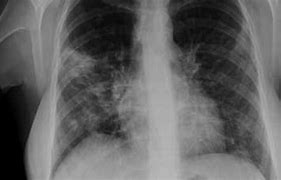 Image result for co_to_znaczy_zapalenie_płuc