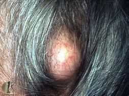 Image result for Sebaceous Cyst Benign Scalp