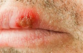 Image result for HIV Canker Sore