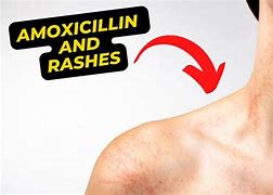 Image result for Amoxicillin Allergy Rash Treatment