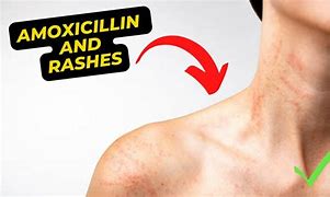 Image result for Amoxicillin Rash Treatment