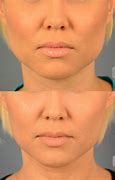 Image result for CoolSculpting Under Chin