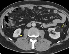 Image result for Kidney Mass CT Scan