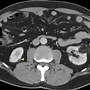 Image result for Kidney Mass CT Scan