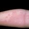 Image result for Food Allergy Reaction Skin Rash