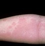 Image result for Severe Allergic Reaction