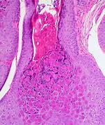 Image result for Child Molluscum Contagiosum Treatment