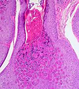 Image result for Molluscum Contagiosum Bandages