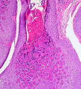 Image result for Molluscum Contagiosum Legs