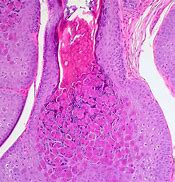 Image result for Molluscum Contagiosum On Black and African American Skin