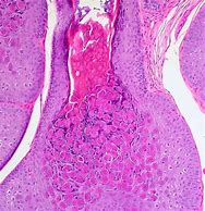 Image result for Molluscum Contagiosum Histopathology