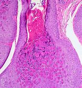 Image result for Molluscum Contagiosum Symptoms in Women