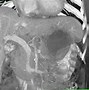 Image result for Gallbladder Cancer CT